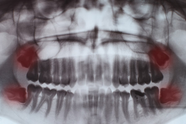 teeth-full-x-ray-2021-08-29-01-04-22-utc-600×400-1